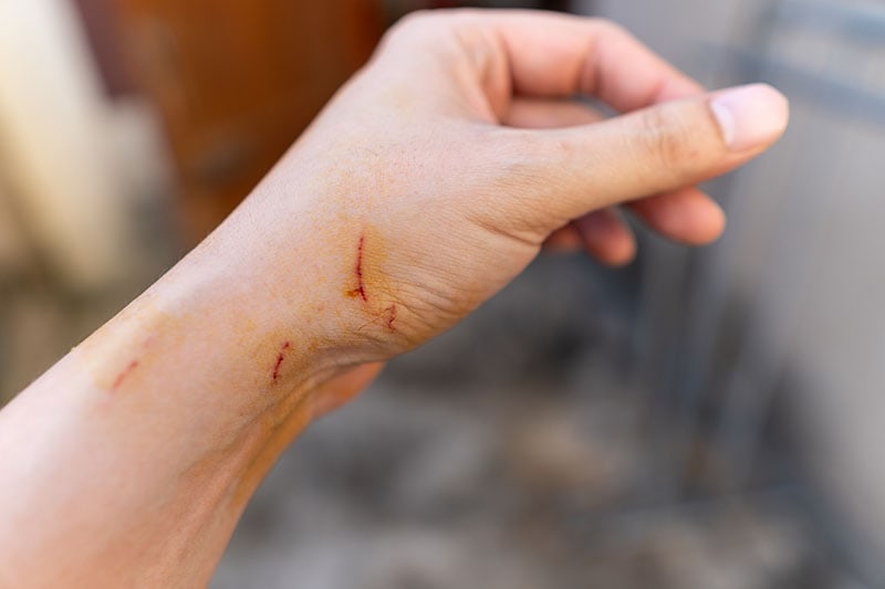A hand with bloody scars from a cat scratch