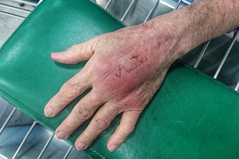 Hand bitten by cat showing signs of infection