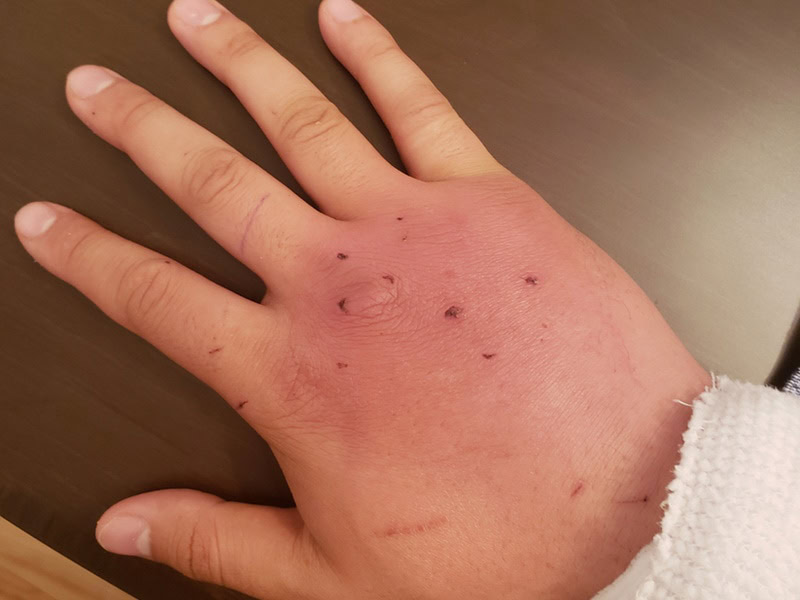 Swelling from a cat bite on hand