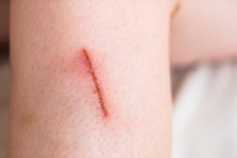 a small scratch by cat on the skin of a little boy's leg