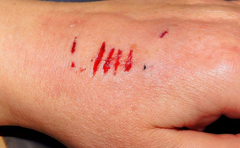 dog bite on hand